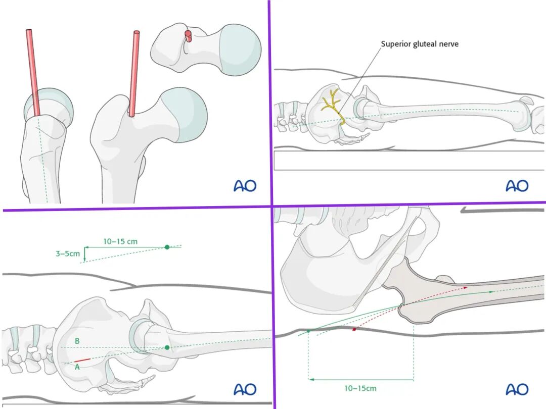 股骨干骨折，为什么“能闭合，不切开；能髓内，不钢板；能顺应，不逆行。”
