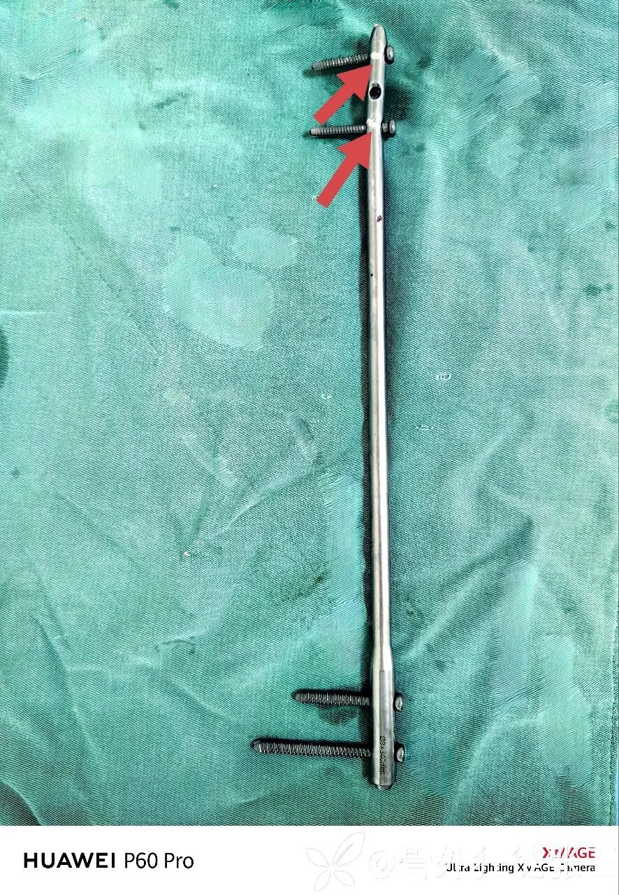 股骨干骨折，为什么“能闭合，不切开；能髓内，不钢板；能顺应，不逆行。”