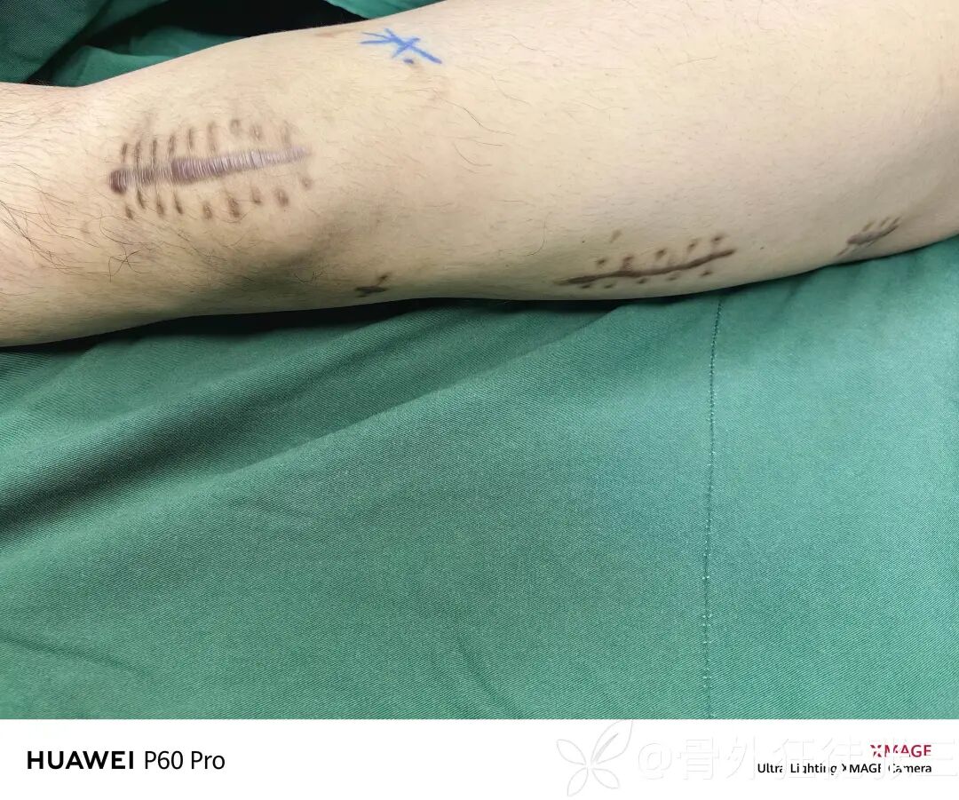 股骨干骨折，为什么“能闭合，不切开；能髓内，不钢板；能顺应，不逆行。”