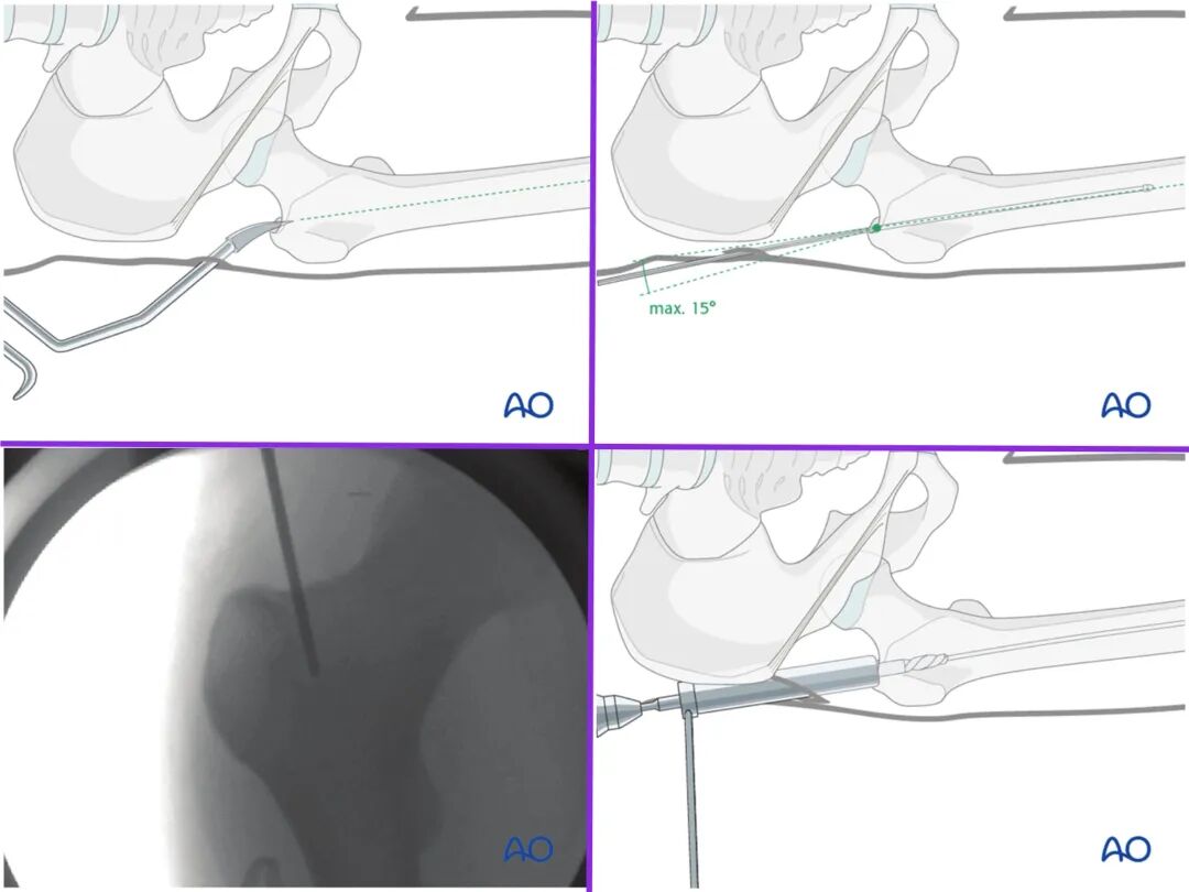 股骨干骨折，为什么“能闭合，不切开；能髓内，不钢板；能顺应，不逆行。”
