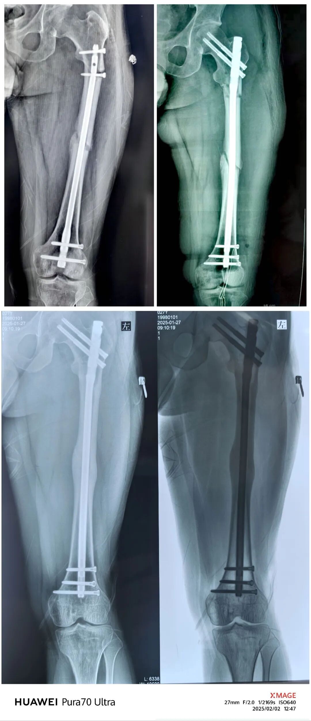 股骨干骨折，为什么“能闭合，不切开；能髓内，不钢板；能顺应，不逆行。”