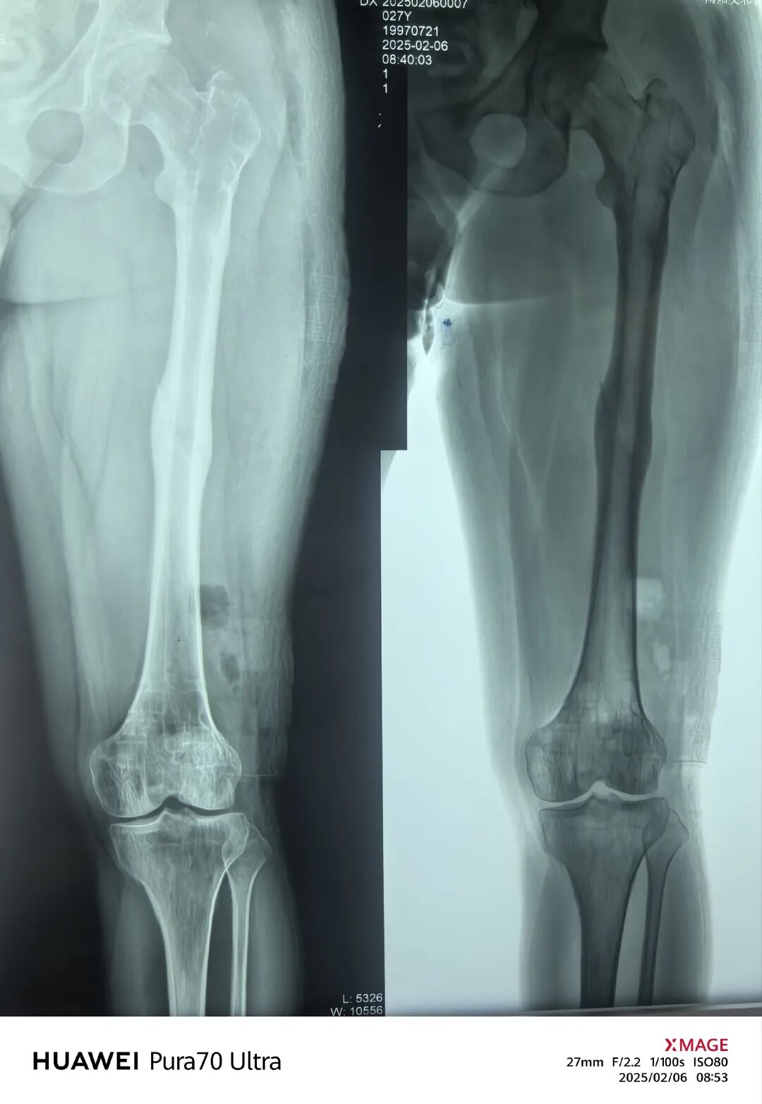 股骨干骨折，为什么“能闭合，不切开；能髓内，不钢板；能顺应，不逆行。”