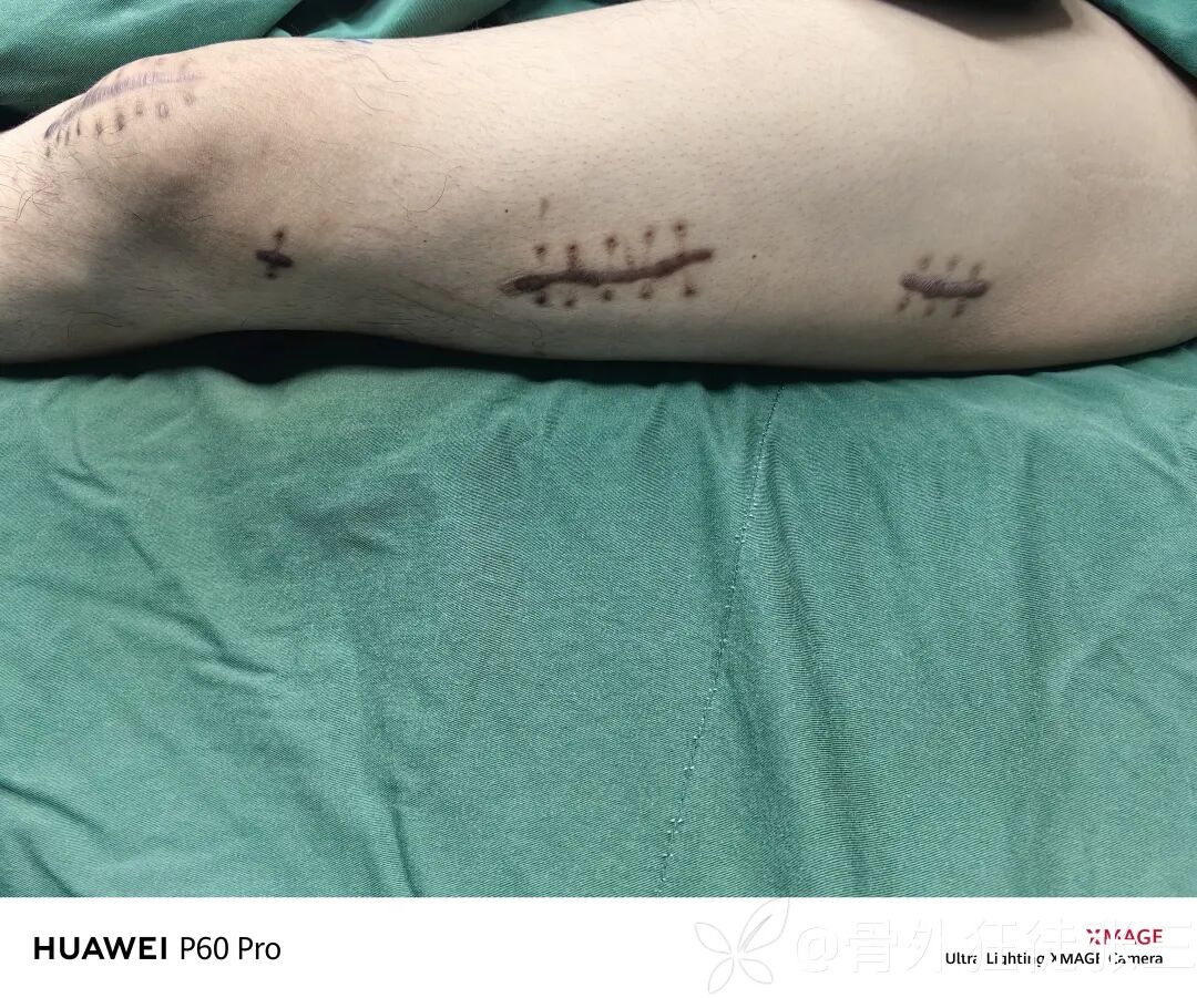 股骨干骨折，为什么“能闭合，不切开；能髓内，不钢板；能顺应，不逆行。”