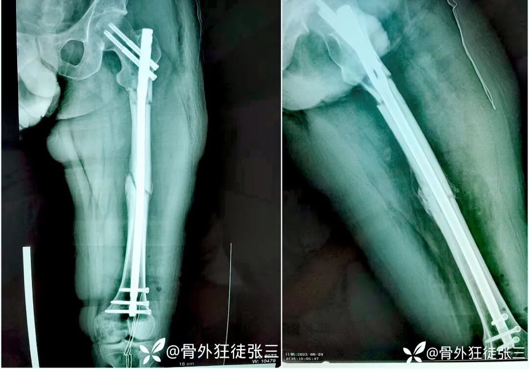 股骨干骨折，为什么“能闭合，不切开；能髓内，不钢板；能顺应，不逆行。”