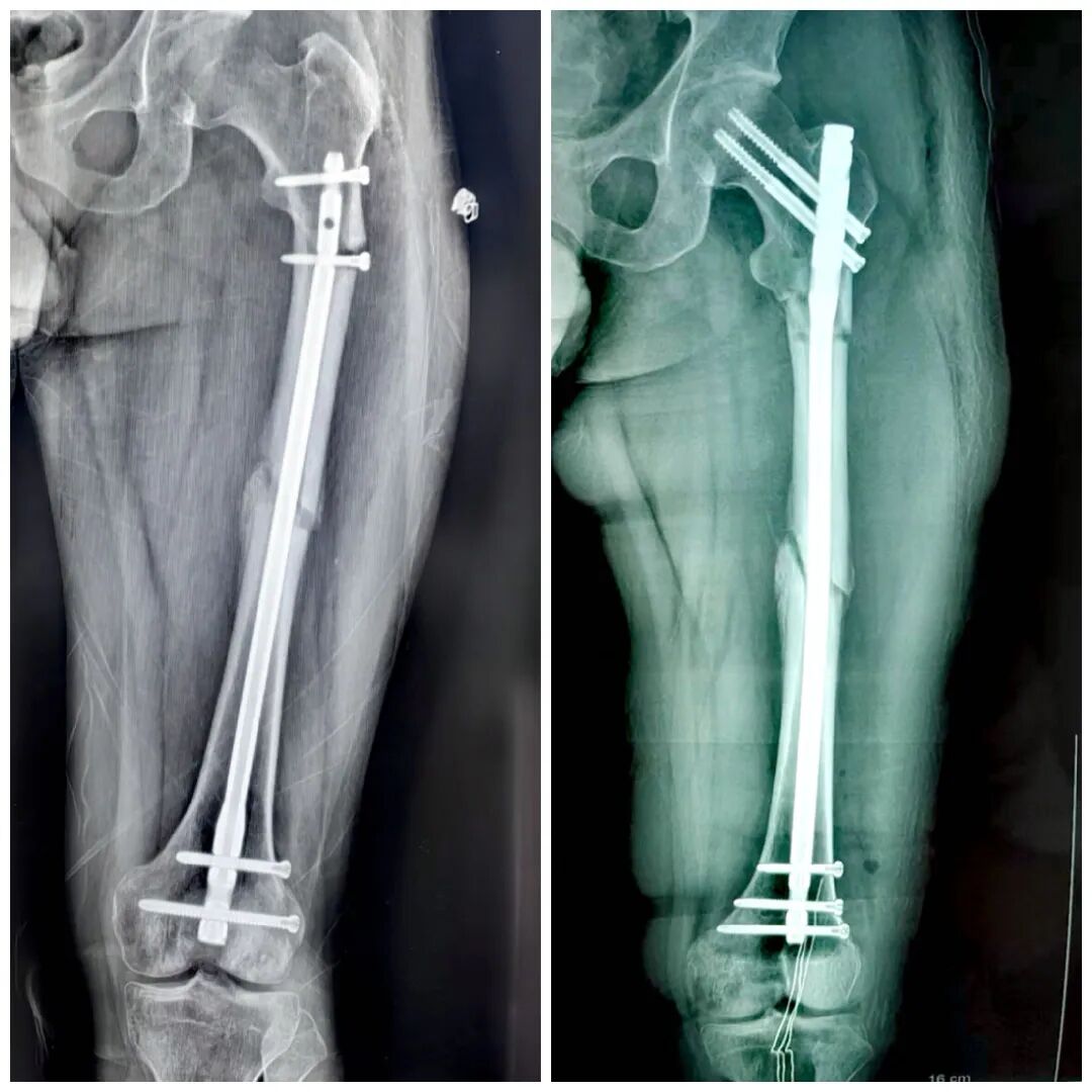 股骨干骨折，为什么“能闭合，不切开；能髓内，不钢板；能顺应，不逆行。”