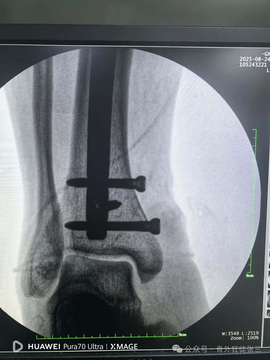 一图学会，髌旁外侧入路胫骨髓内钉