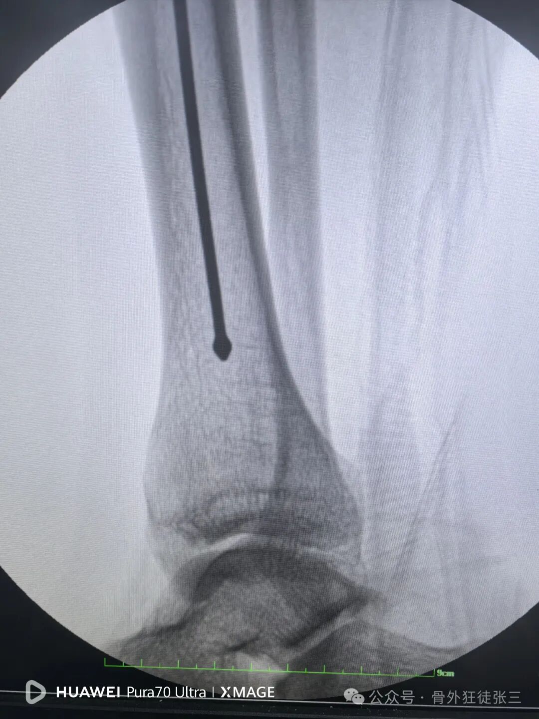 一图学会，髌旁外侧入路胫骨髓内钉