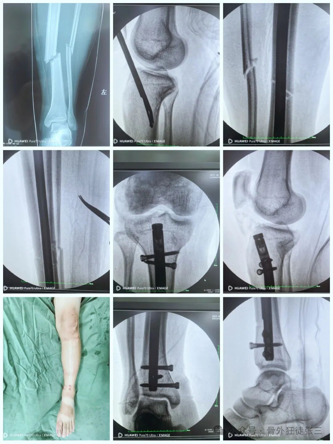 一图学会，髌旁外侧入路胫骨髓内钉