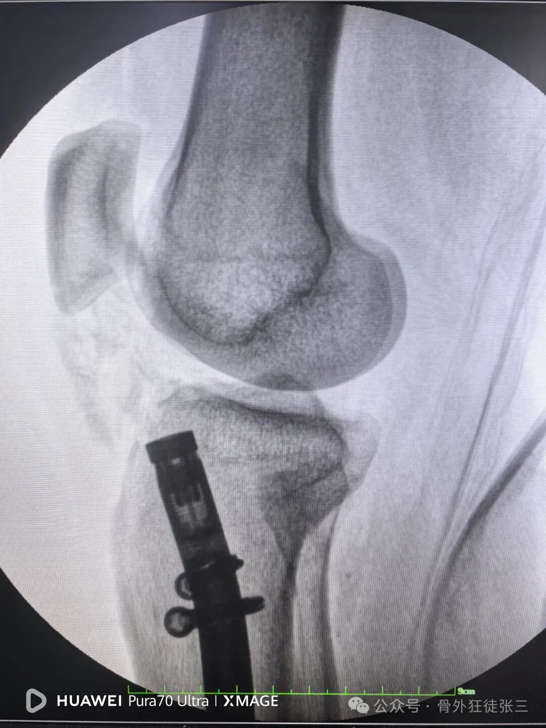 一图学会，髌旁外侧入路胫骨髓内钉
