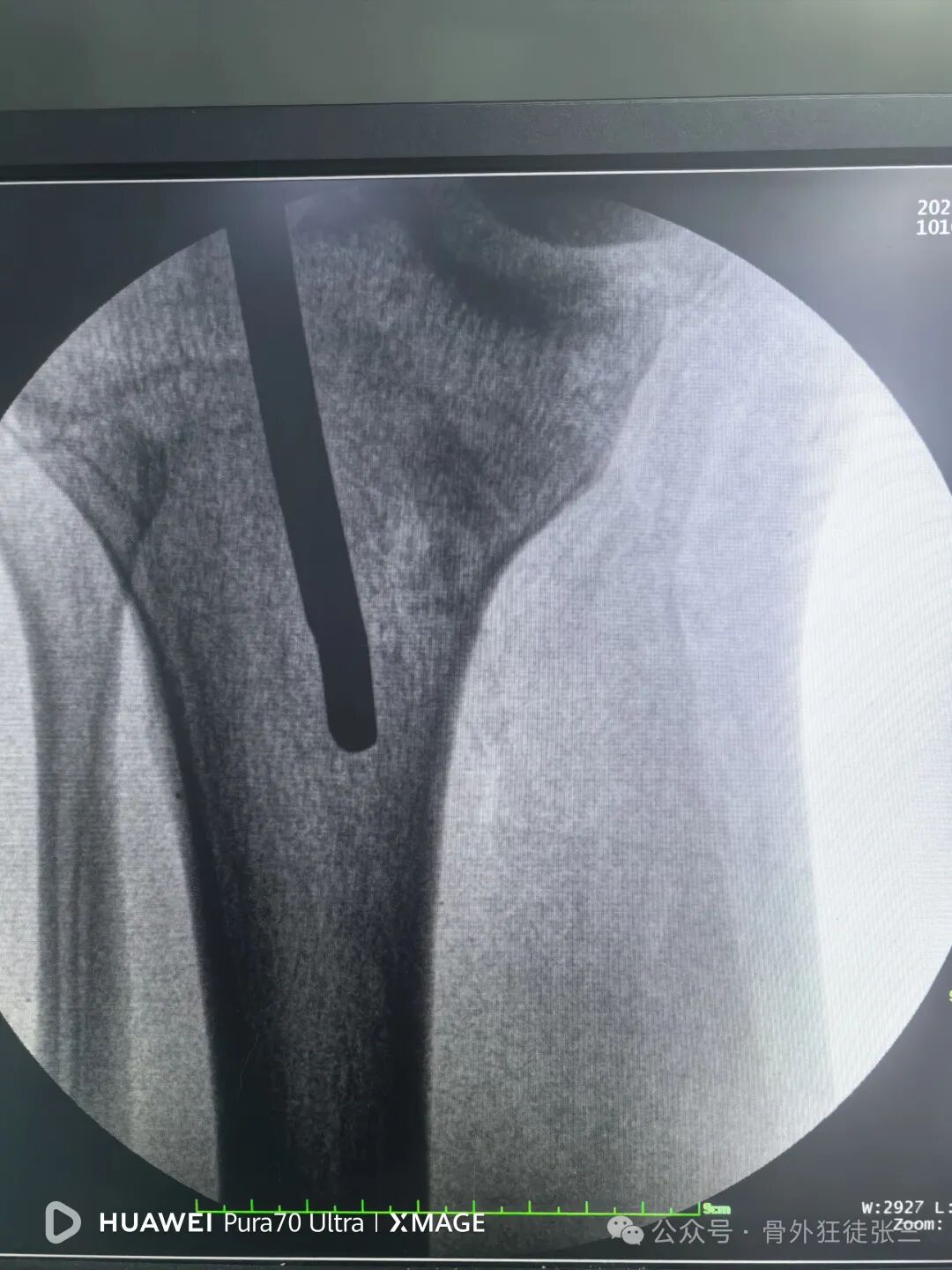 一图学会，髌旁外侧入路胫骨髓内钉