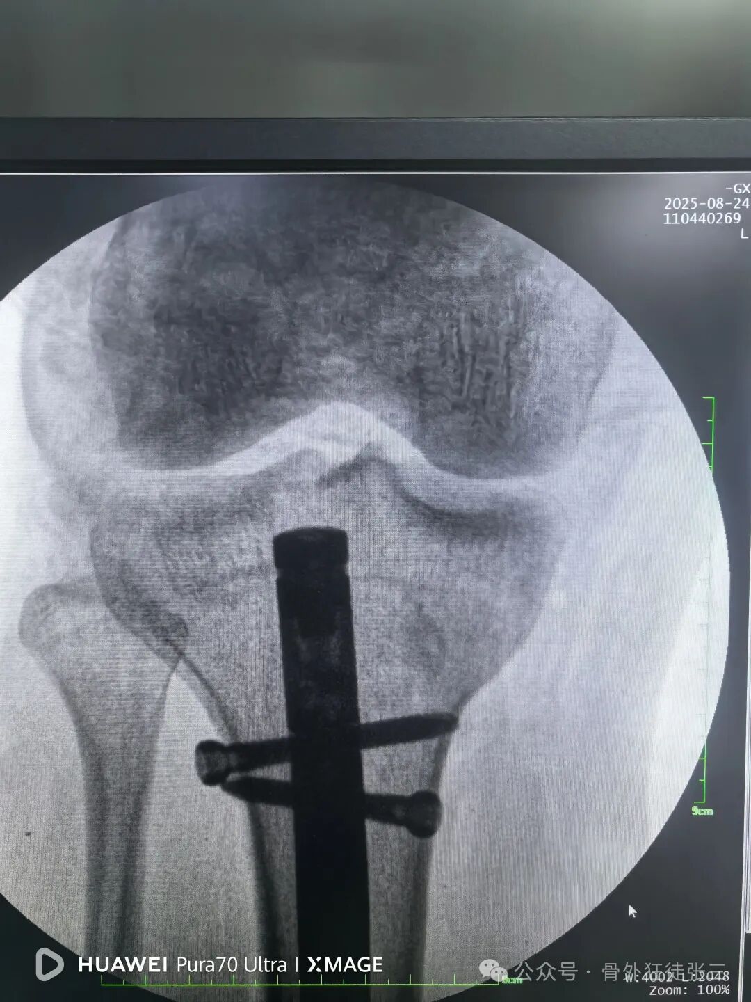 一图学会，髌旁外侧入路胫骨髓内钉