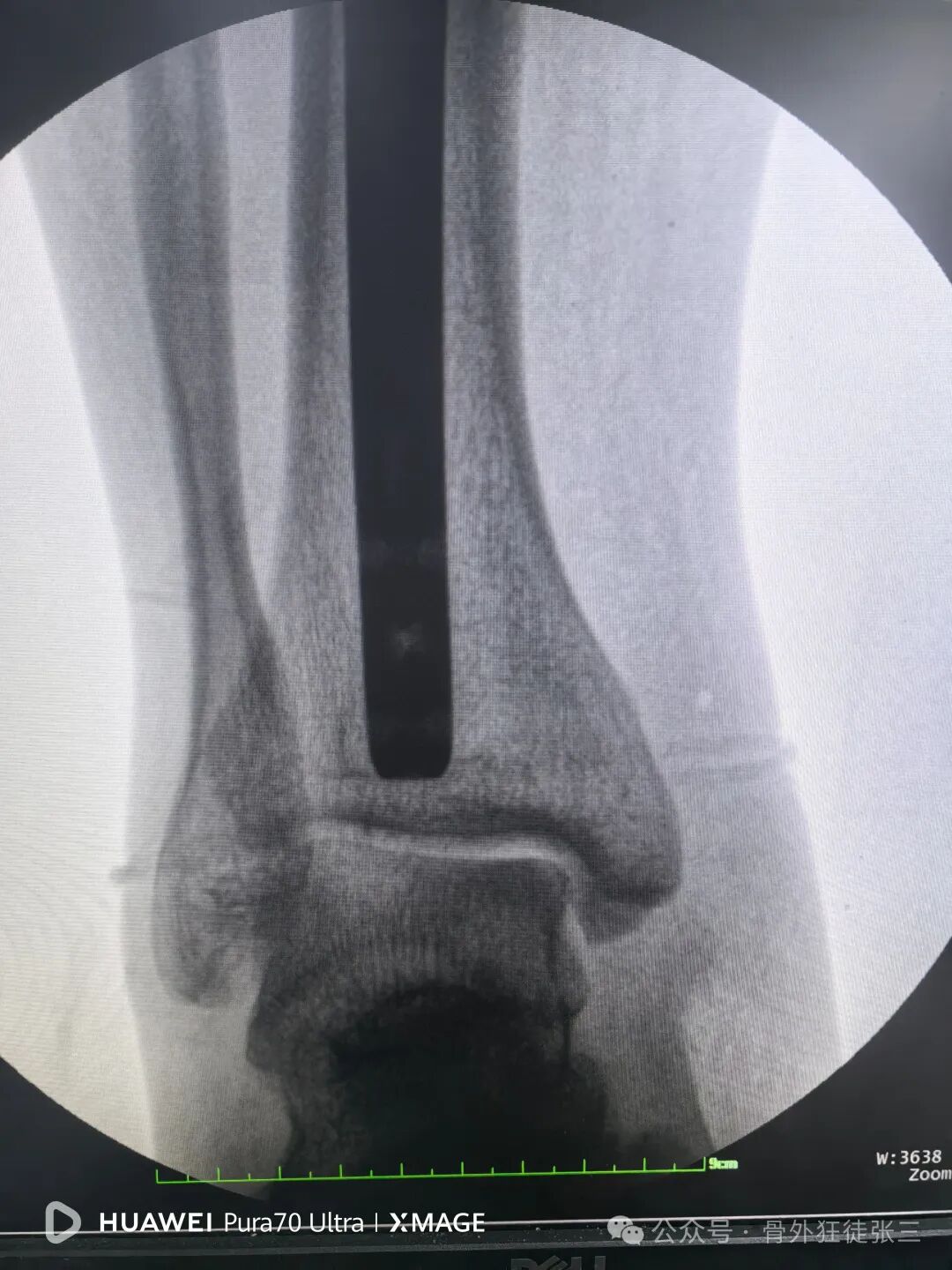 一图学会，髌旁外侧入路胫骨髓内钉