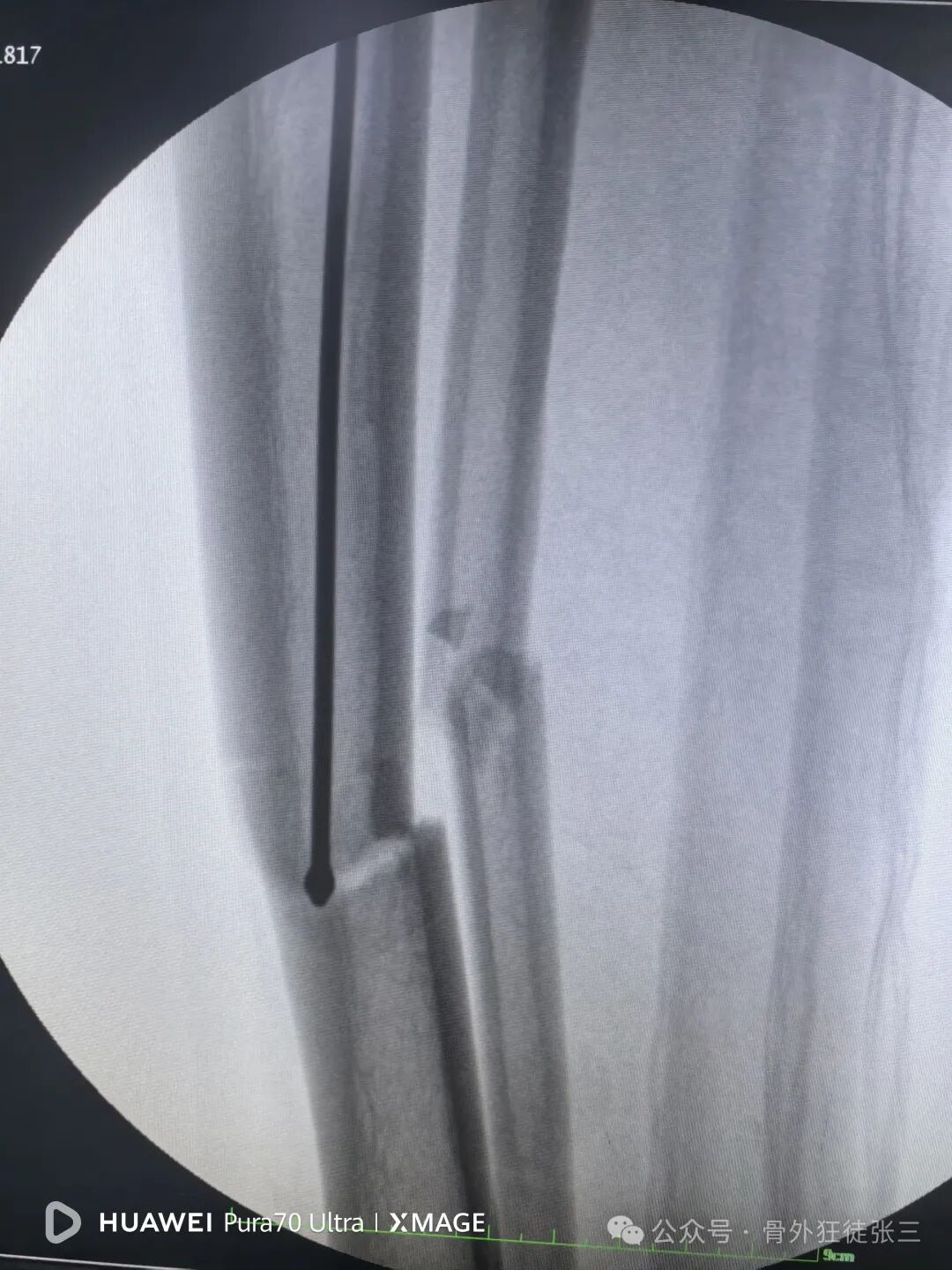 一图学会，髌旁外侧入路胫骨髓内钉