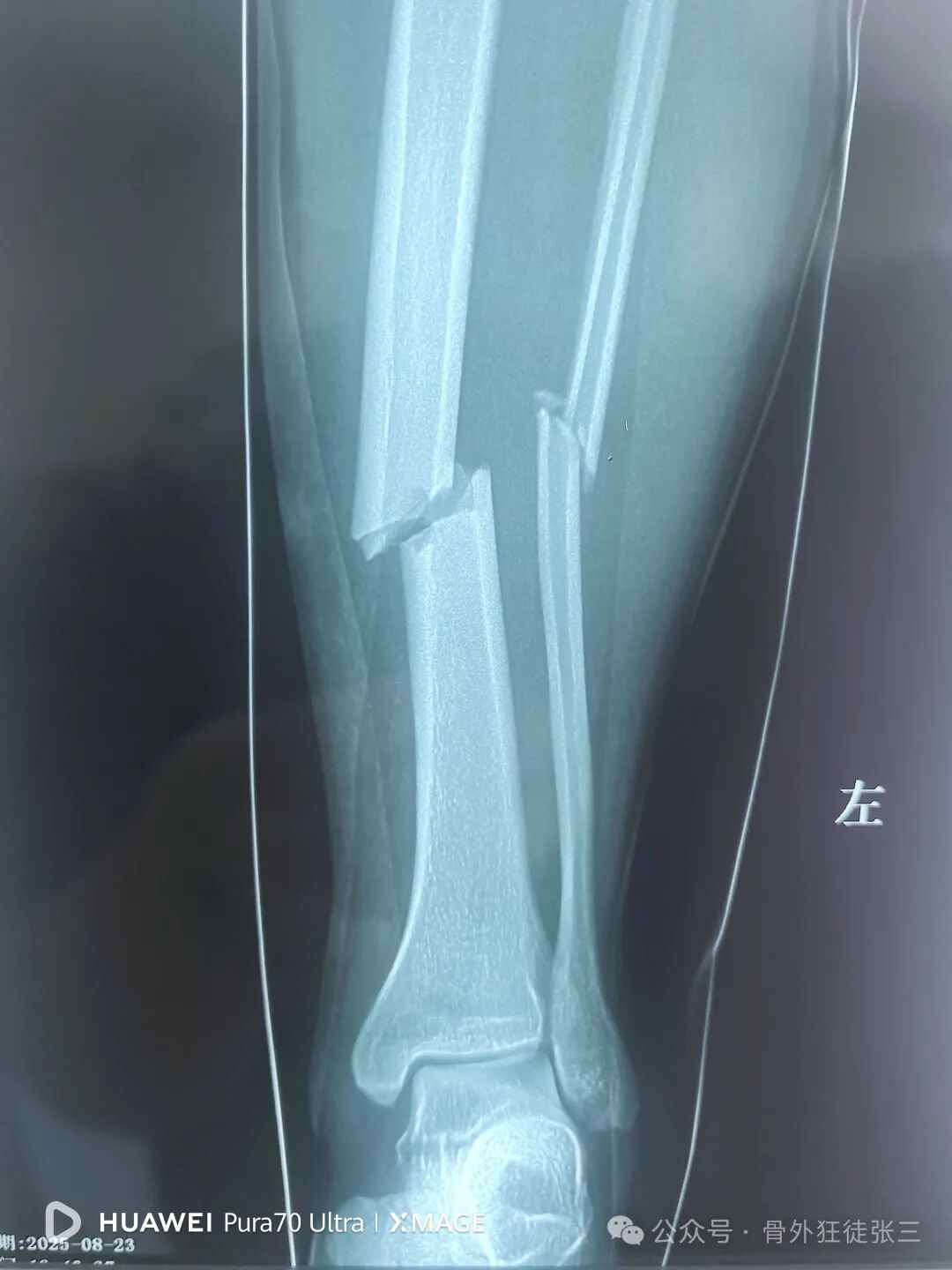 一图学会，髌旁外侧入路胫骨髓内钉