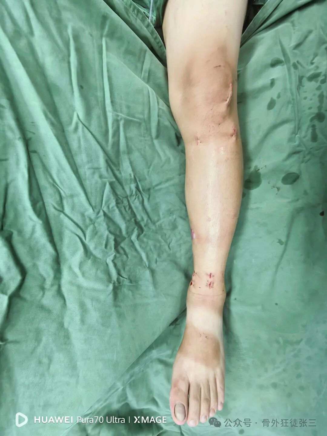 一图学会，髌旁外侧入路胫骨髓内钉