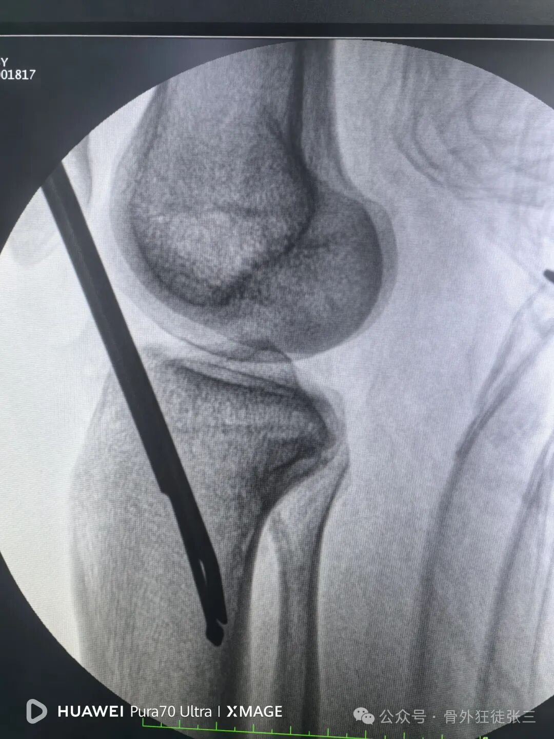 一图学会，髌旁外侧入路胫骨髓内钉