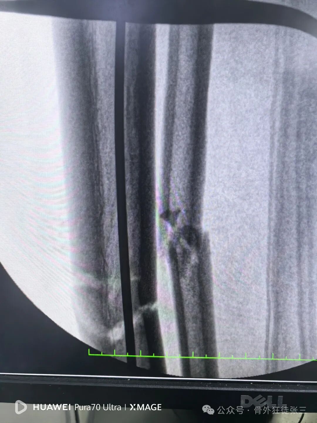 一图学会，髌旁外侧入路胫骨髓内钉