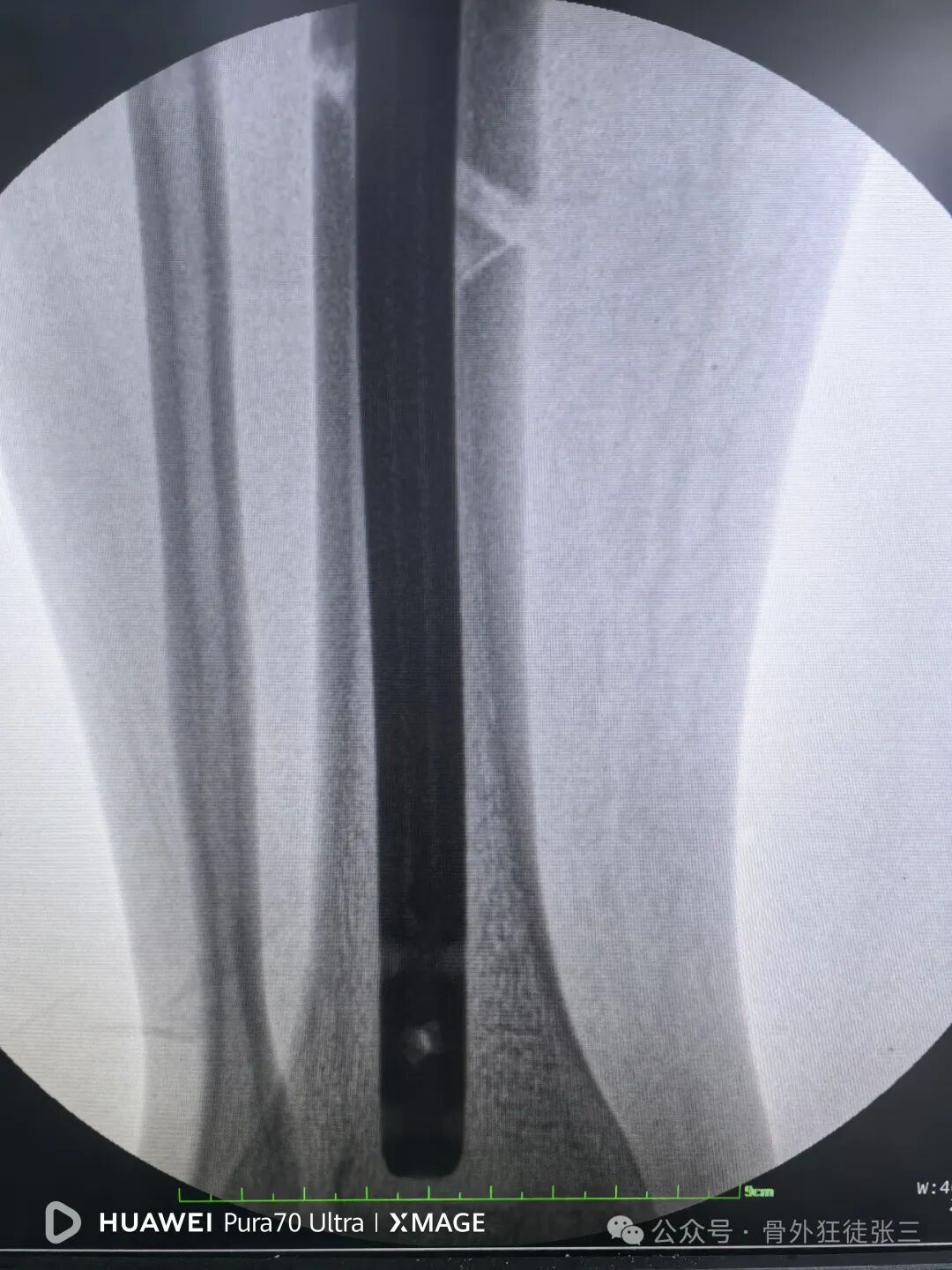 一图学会，髌旁外侧入路胫骨髓内钉