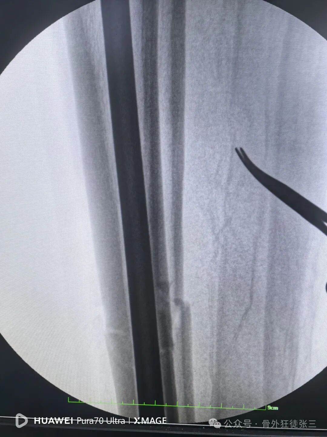 一图学会，髌旁外侧入路胫骨髓内钉