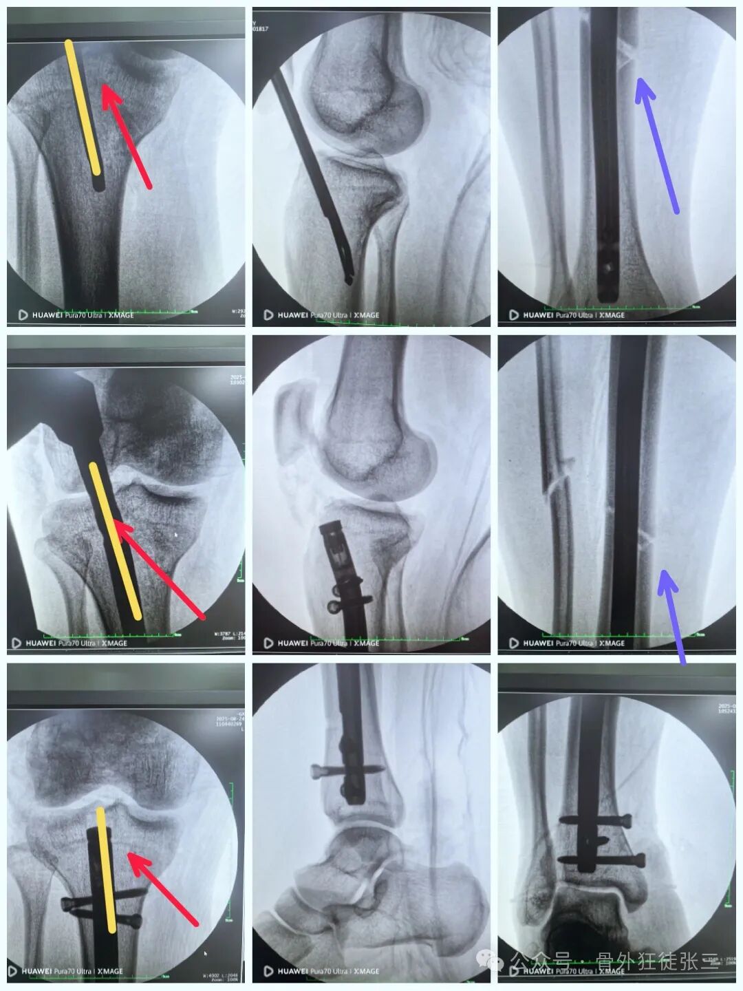 一图学会，髌旁外侧入路胫骨髓内钉