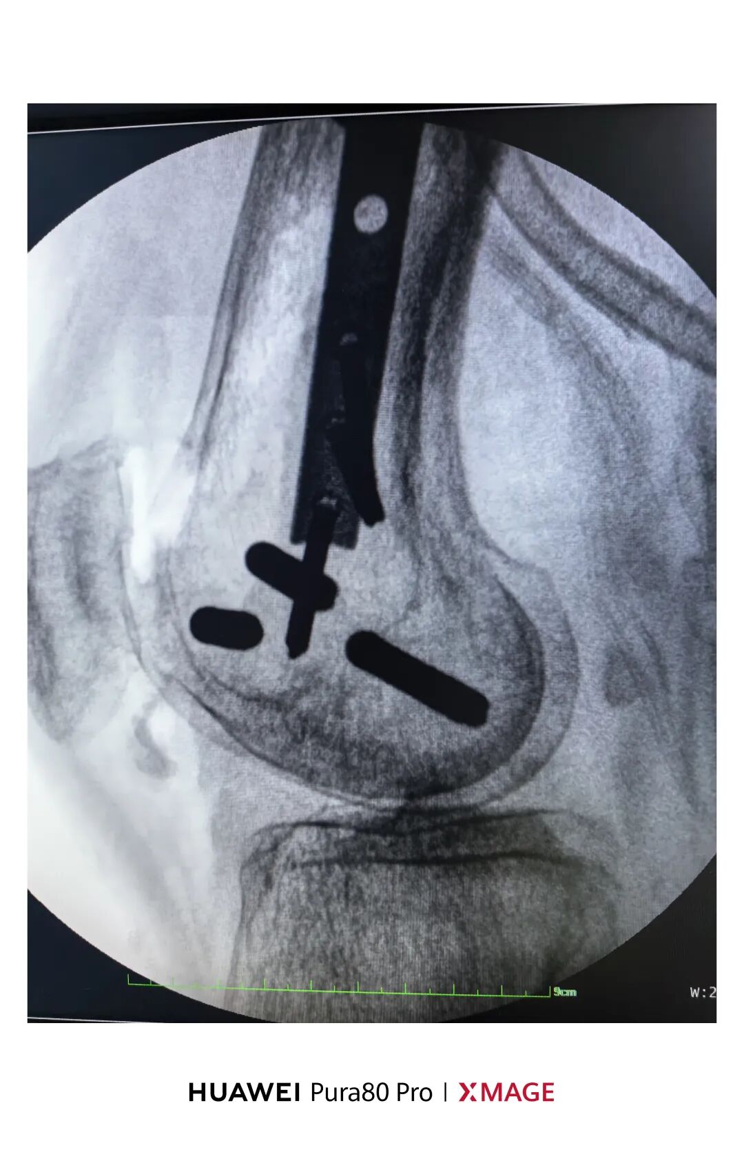 跟着AO做股骨内髁
