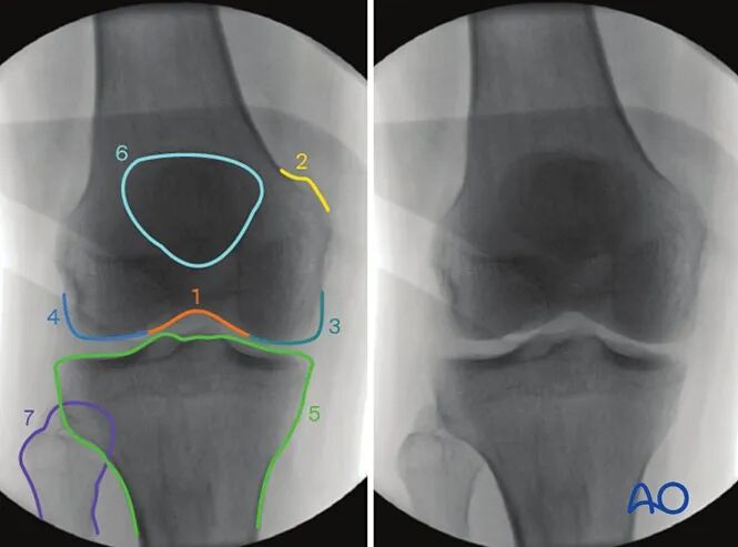 跟着AO做股骨内髁
