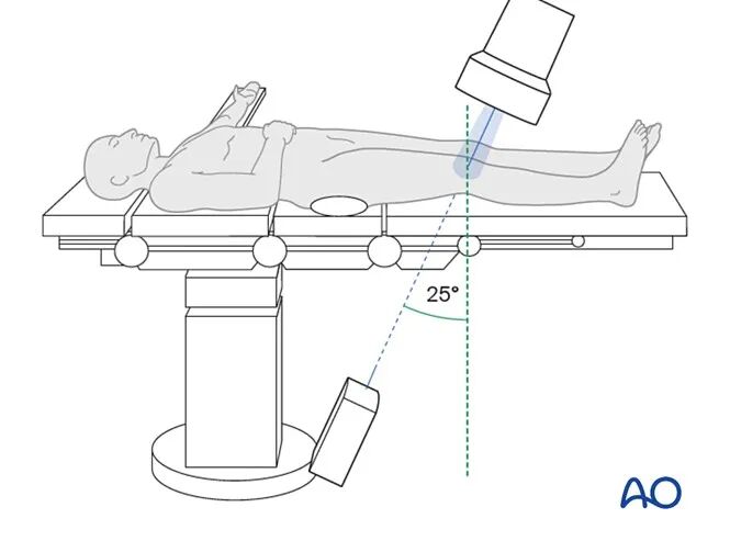 跟着AO做股骨内髁