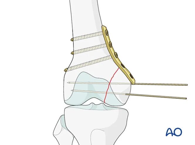 跟着AO做股骨内髁