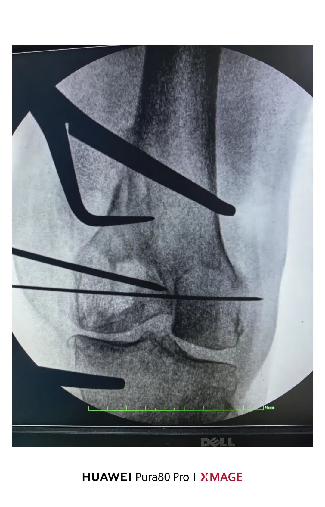 跟着AO做股骨内髁