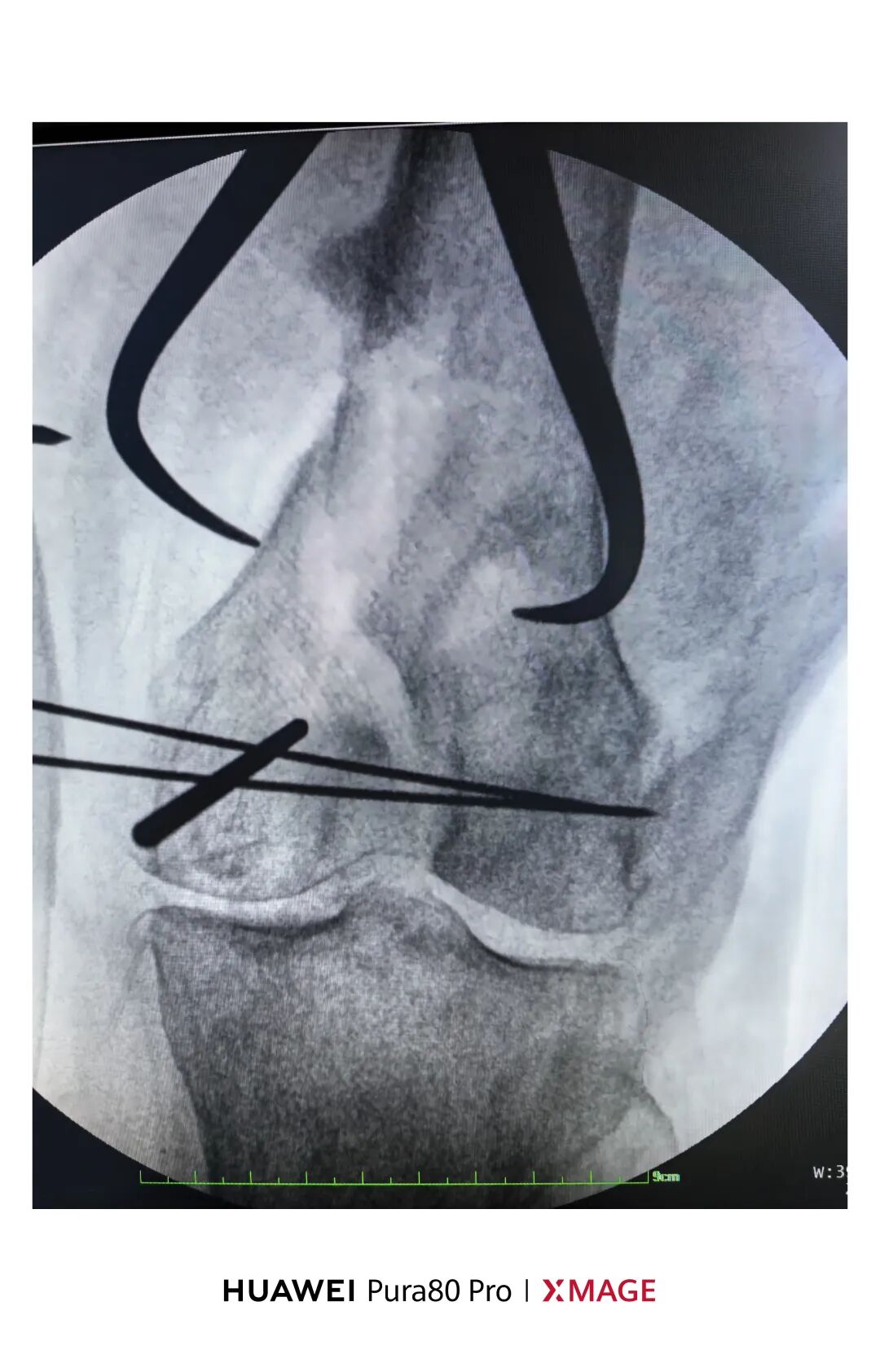 跟着AO做股骨内髁