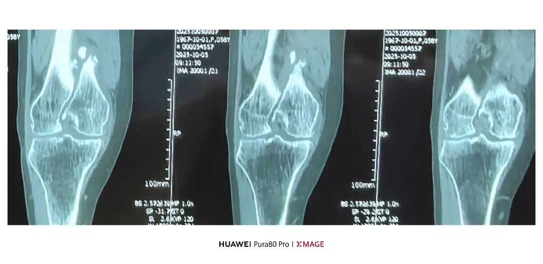 跟着AO做股骨内髁