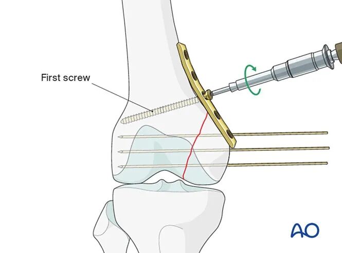 跟着AO做股骨内髁