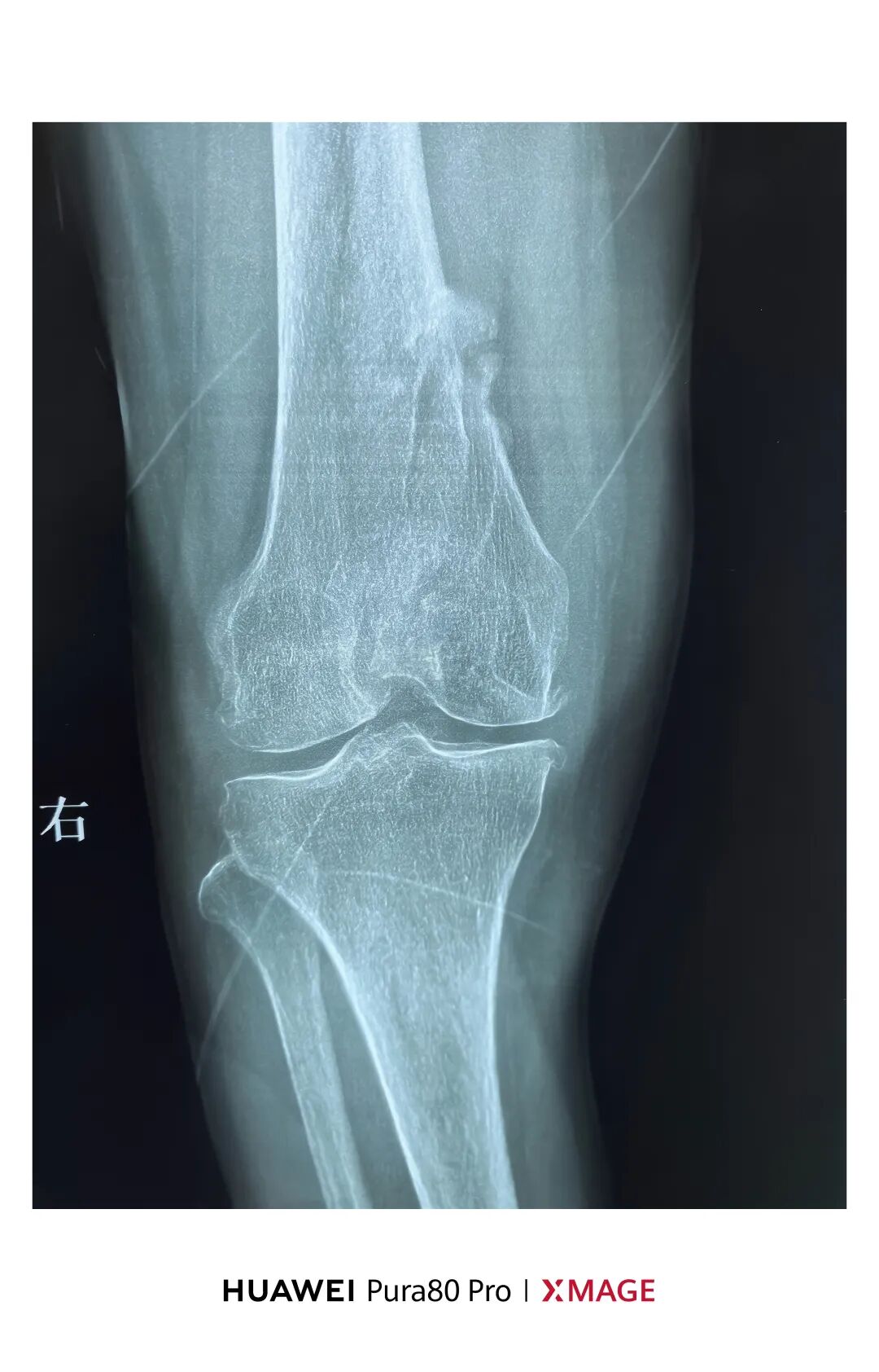 跟着AO做股骨内髁