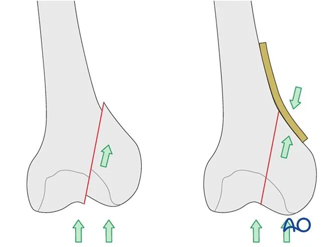 跟着AO做股骨内髁