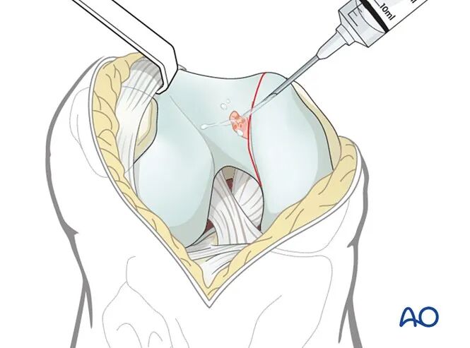 跟着AO做股骨内髁