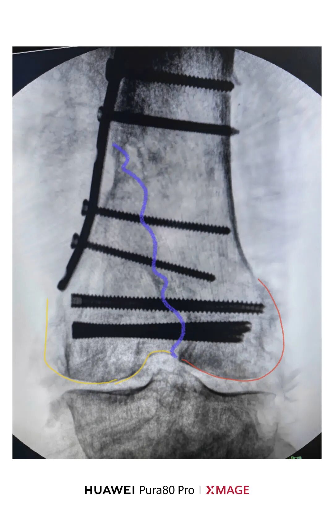 跟着AO做股骨内髁