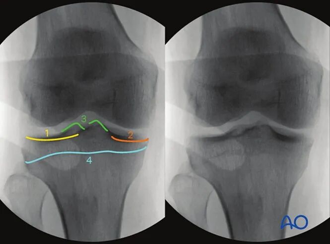 跟着AO做股骨内髁