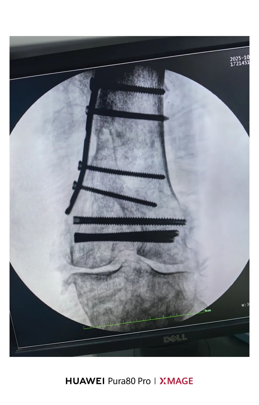 跟着AO做股骨内髁