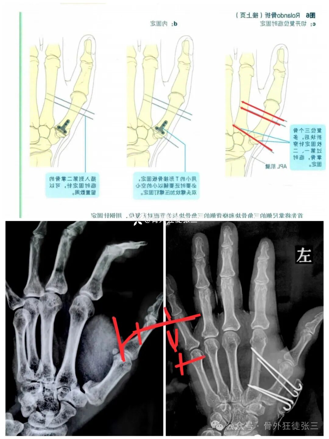 克氏针支架在Winterstein-Bennett-Rolando-反Bennett骨折中的应用