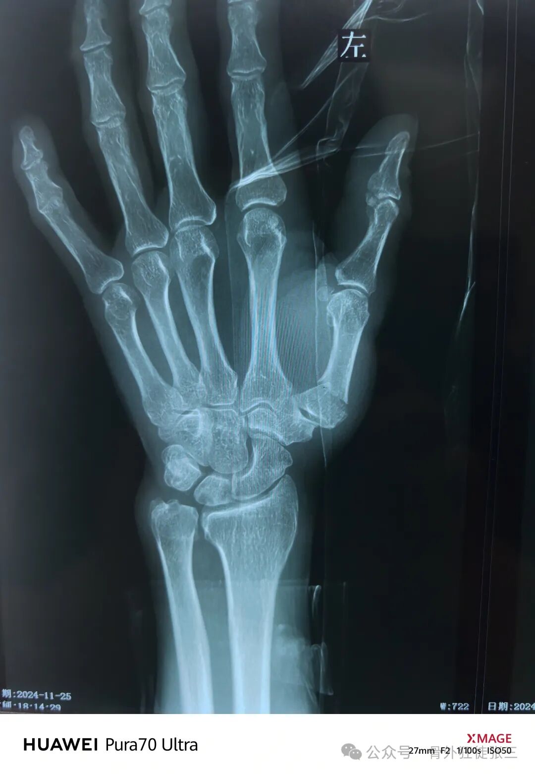 克氏针支架在Winterstein-Bennett-Rolando-反Bennett骨折中的应用