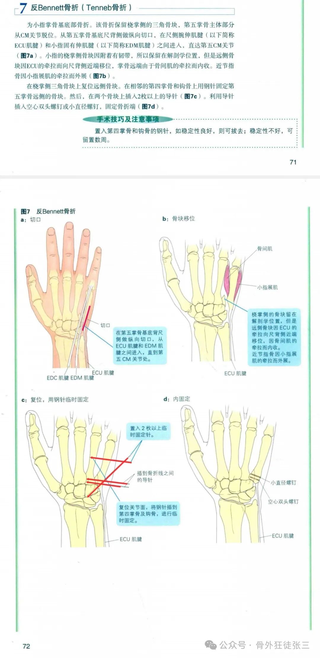 克氏针支架在Winterstein-Bennett-Rolando-反Bennett骨折中的应用