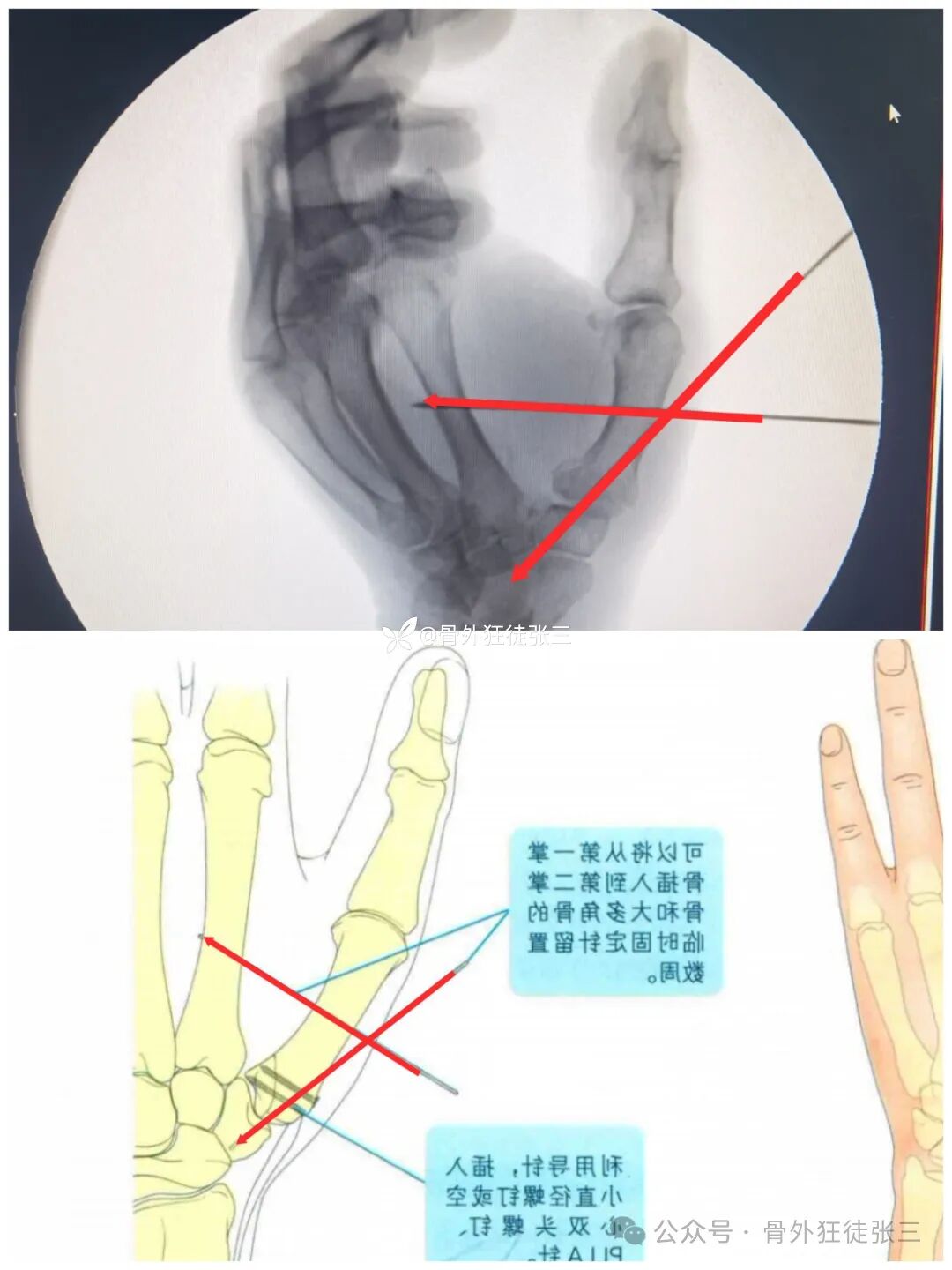克氏针支架在Winterstein-Bennett-Rolando-反Bennett骨折中的应用
