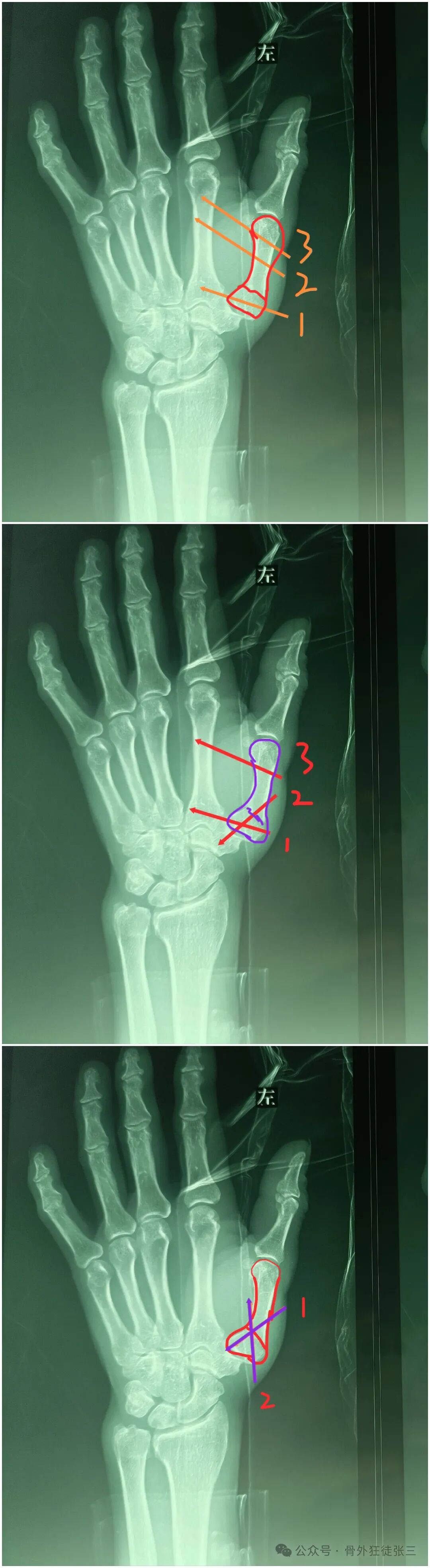 克氏针支架在Winterstein-Bennett-Rolando-反Bennett骨折中的应用
