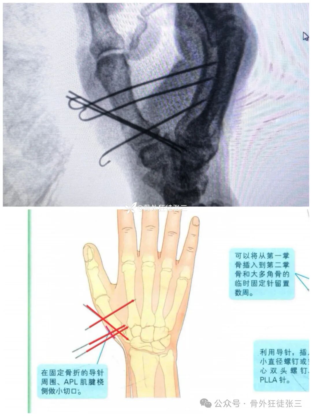 克氏针支架在Winterstein-Bennett-Rolando-反Bennett骨折中的应用