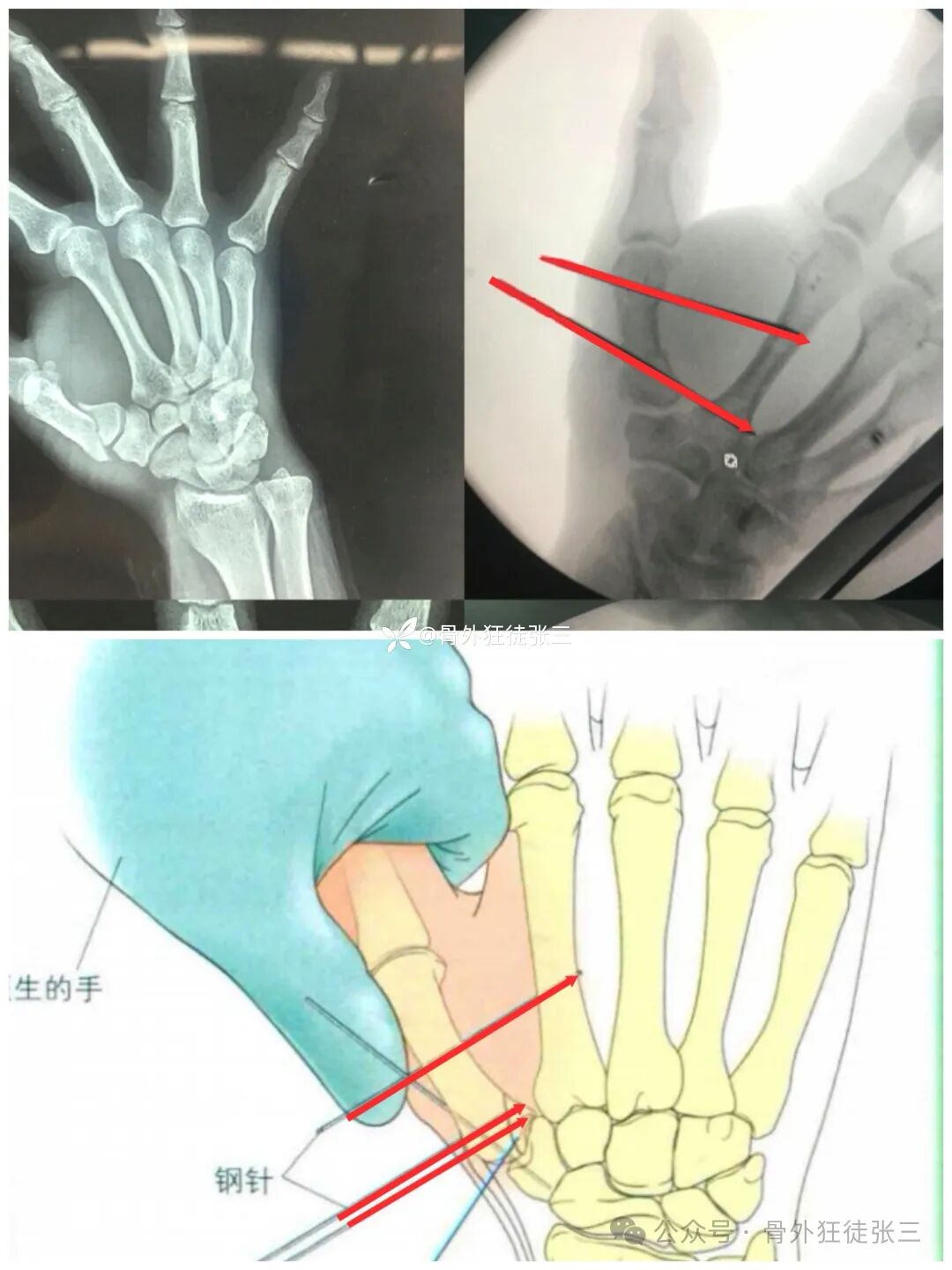 克氏针支架在Winterstein-Bennett-Rolando-反Bennett骨折中的应用