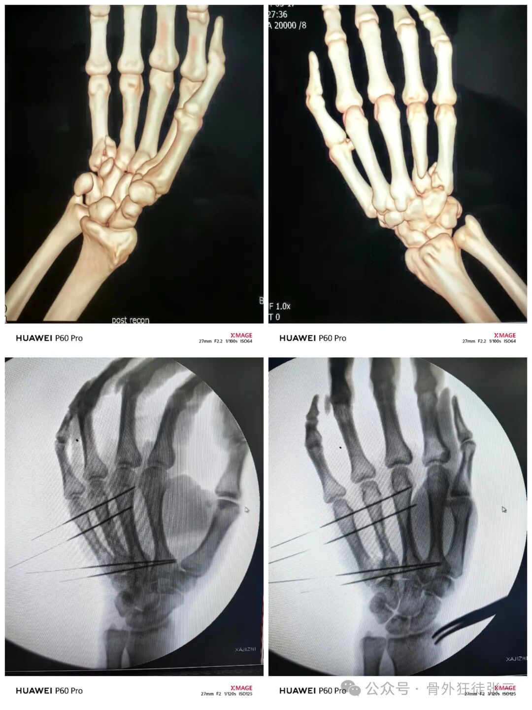 克氏针支架在Winterstein-Bennett-Rolando-反Bennett骨折中的应用