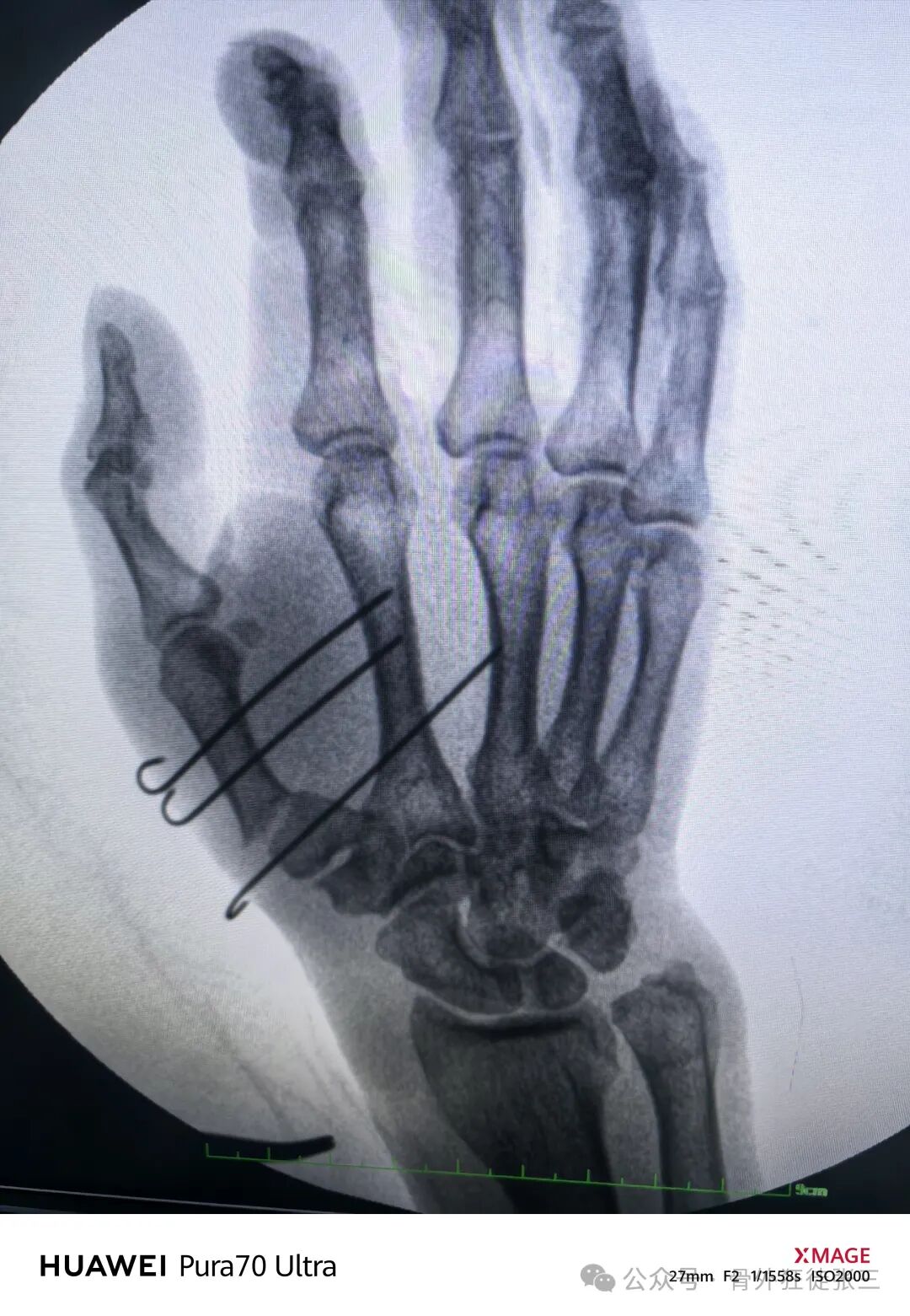 克氏针支架在Winterstein-Bennett-Rolando-反Bennett骨折中的应用