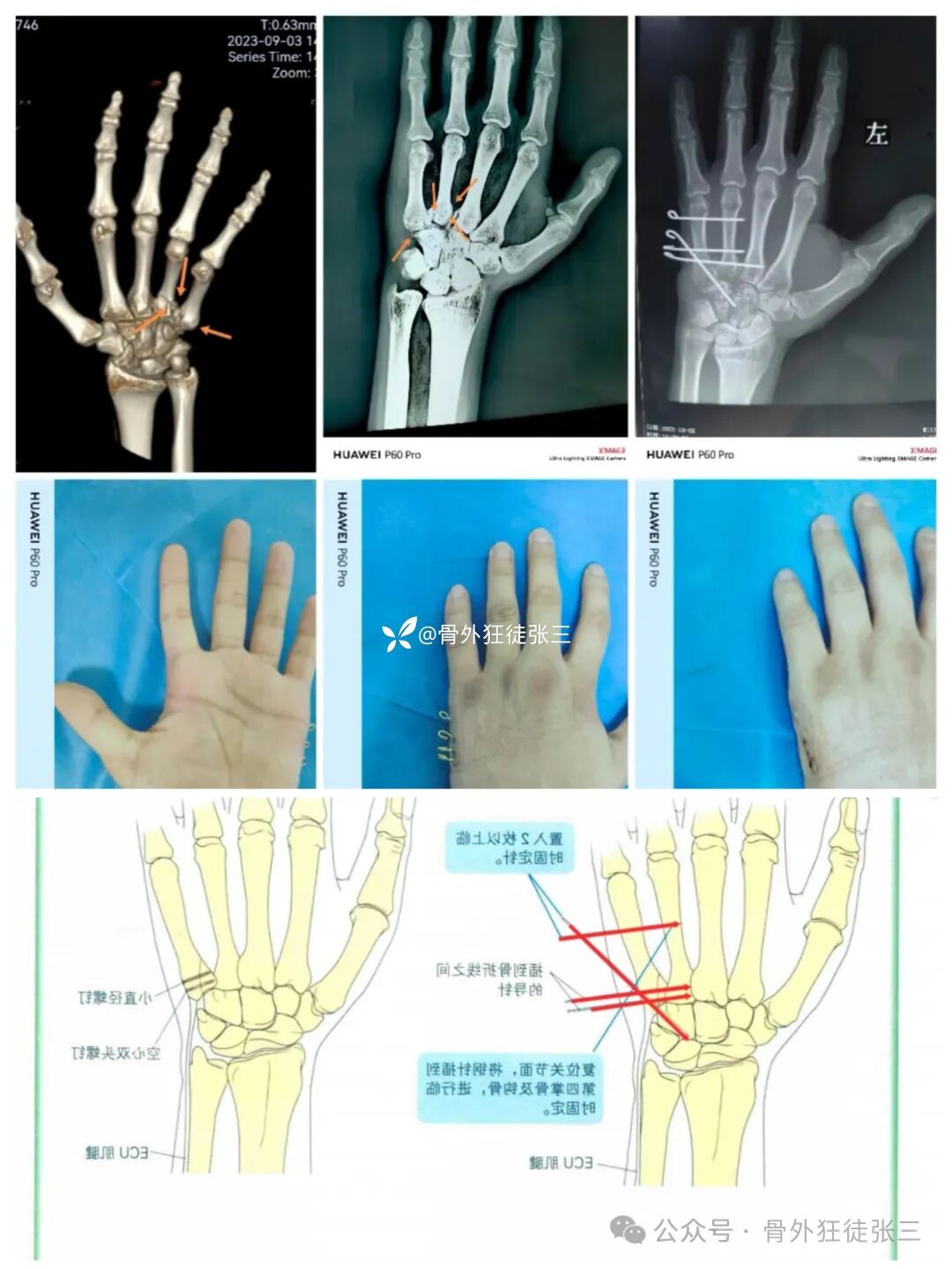 克氏针支架在Winterstein-Bennett-Rolando-反Bennett骨折中的应用