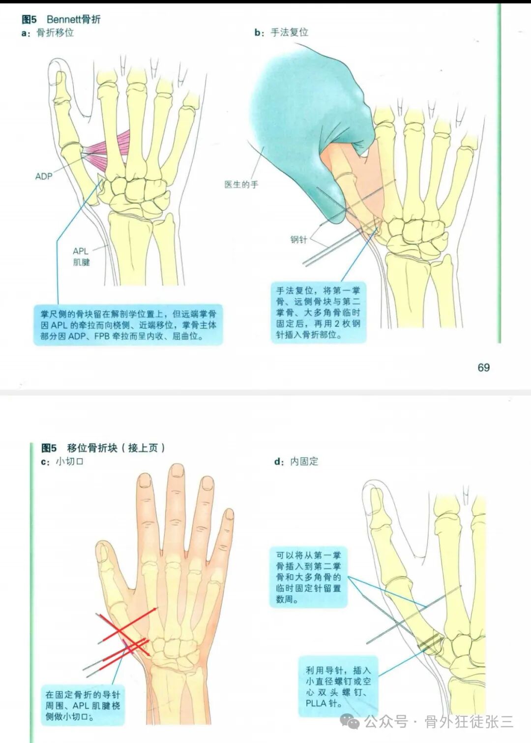 克氏针支架在Winterstein-Bennett-Rolando-反Bennett骨折中的应用