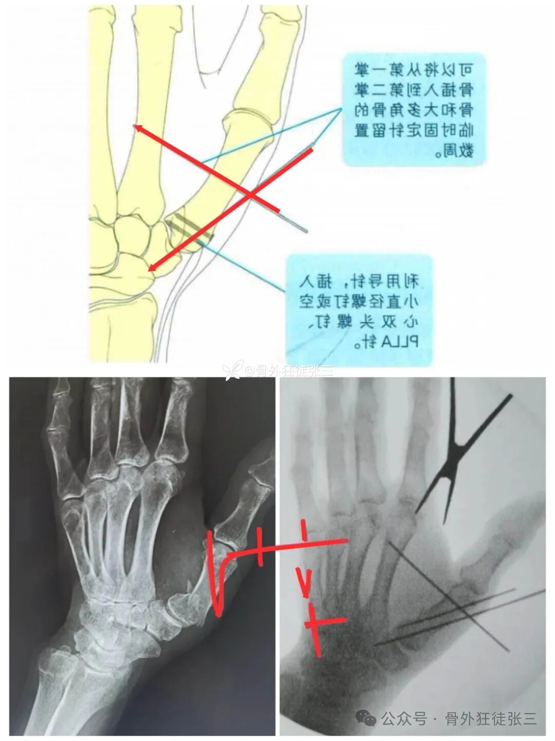 克氏针支架在Winterstein-Bennett-Rolando-反Bennett骨折中的应用